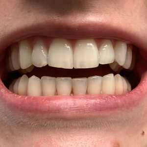 Straight Teeth Direct Reviews - Read Reviews on