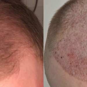 BHT Hair Clinic Reviews - Read Reviews on  Before You Buy  