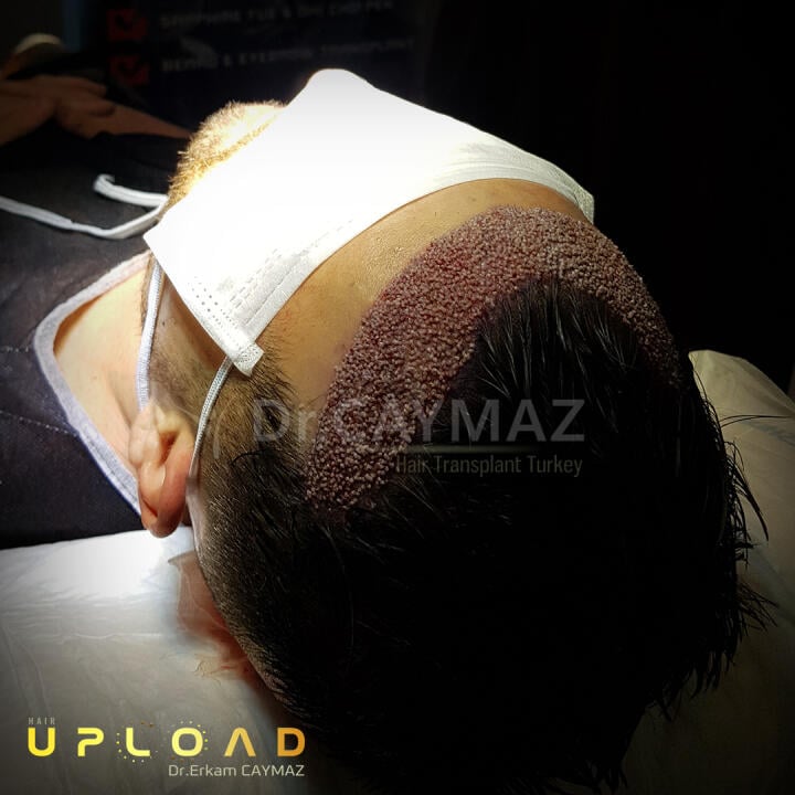 Hair Upload Clinic - Hair Transplant Turkey Istanbul Reviews Best Cost | Sapphire FUE DHI & Dr.Erkam 5 star review on 14th January 2020