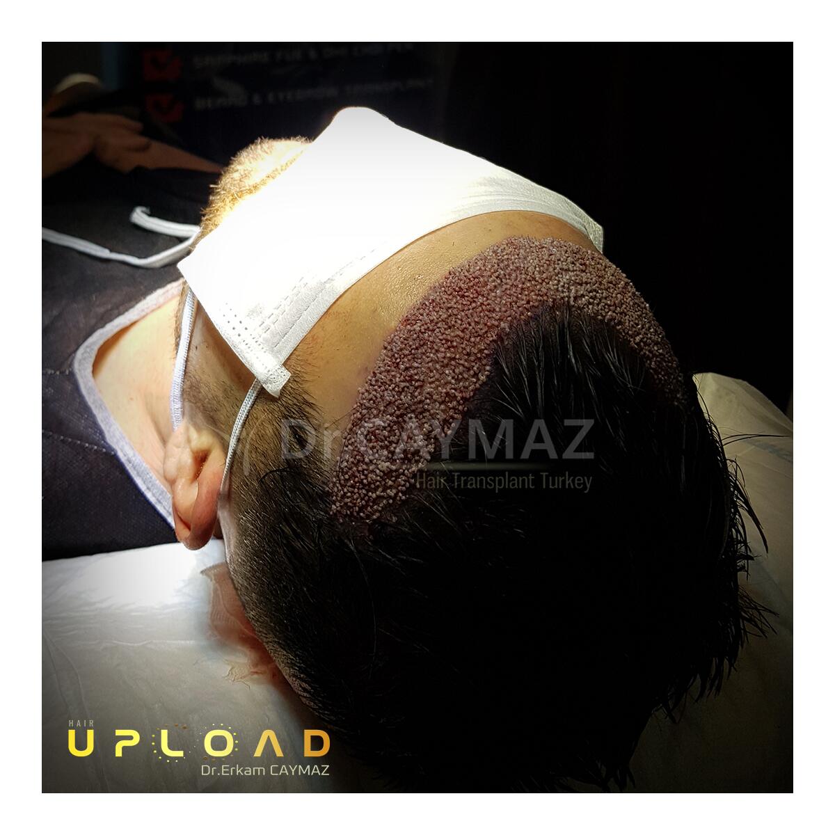 Hair Upload Clinic - Hair Transplant Turkey Istanbul Reviews Best Cost | Sapphire FUE DHI & Dr.Erkam 5 star review on 14th January 2020
