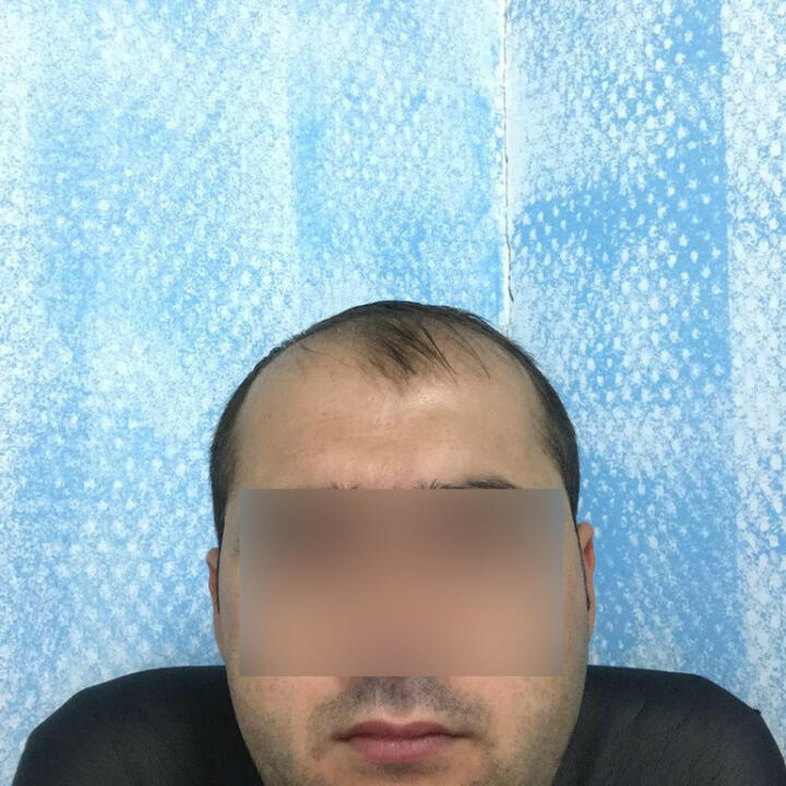 Hair Upload Clinic - Hair Transplant Turkey Istanbul Reviews Best Cost | Sapphire FUE DHI & Dr.Erkam 5 star review on 5th July 2020