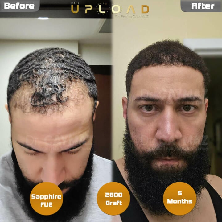 Hair Upload Clinic - Hair Transplant Turkey Istanbul Reviews Best Cost | Sapphire FUE DHI & Dr.Erkam 5 star review on 2nd April 2023