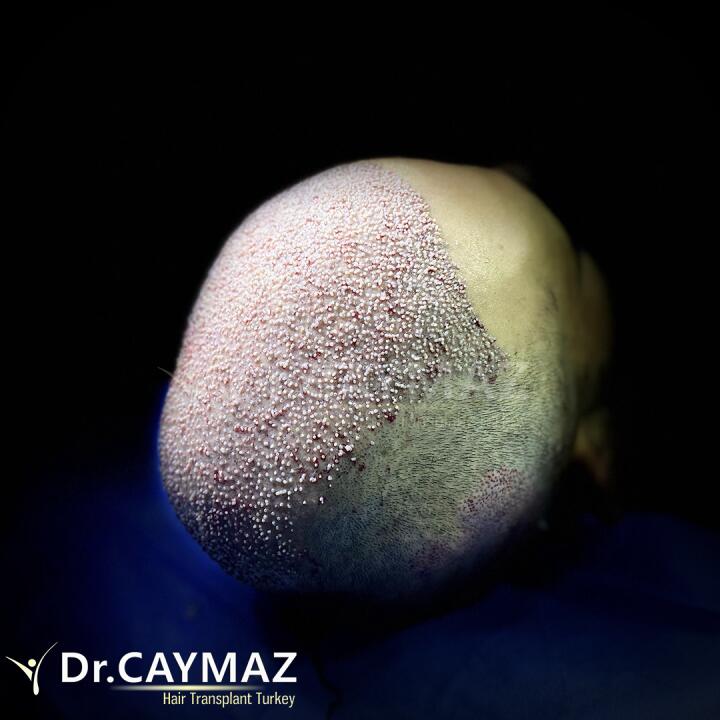 Hair Upload Clinic - Hair Transplant Turkey Istanbul Reviews Best Cost | Sapphire FUE DHI & Dr.Erkam 5 star review on 17th October 2020
