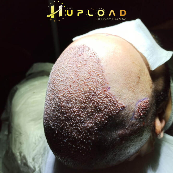 Hair Upload Clinic - Hair Transplant Turkey Istanbul Reviews Best Cost | Sapphire FUE DHI & Dr.Erkam 5 star review on 20th December 2020