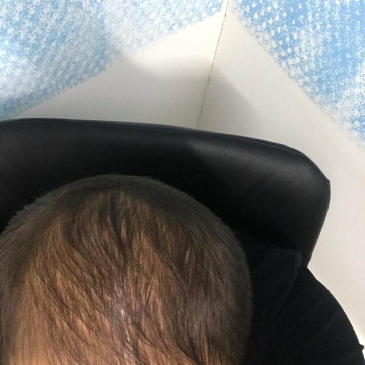 Hair Upload Clinic - Hair Transplant Turkey Istanbul Reviews Best Cost | Sapphire FUE DHI & Dr.Erkam 5 star review on 5th July 2020