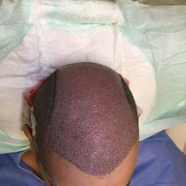 Hair Upload Clinic - Hair Transplant Turkey Istanbul Reviews Best Cost | Sapphire FUE DHI & Dr.Erkam 5 star review on 29th October 2018