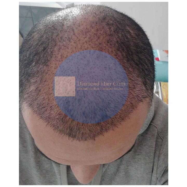 Diamond Hair Clinic & Dr. Mehmet Demircioglu - Hair Transplant Turkey Reviews 2024 5 star review on 31st December 2019