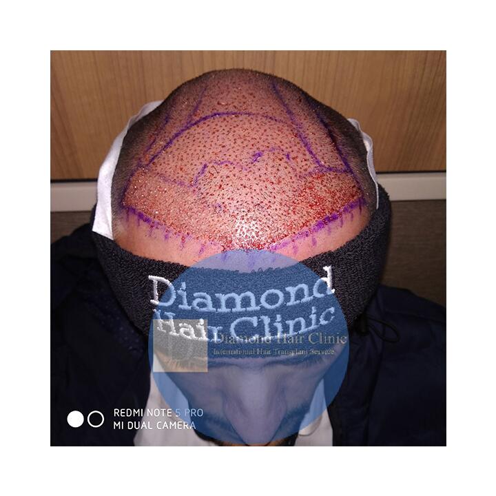 Diamond Hair Clinic & Dr. Mehmet Demircioglu - Hair Transplant Turkey Reviews 2024 5 star review on 31st December 2019