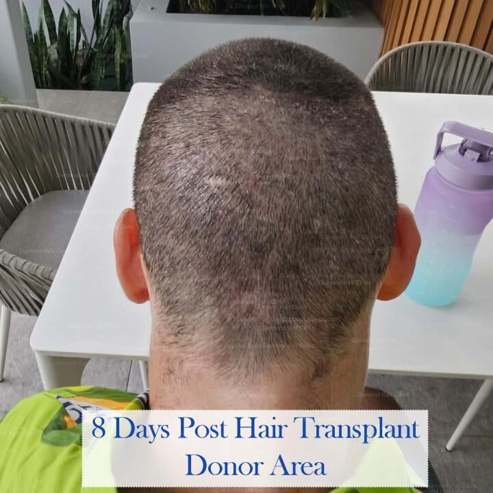 Diamond Hair Clinic & Dr. Mehmet Demircioglu - Hair Transplant Turkey Reviews 2024 5 star review on 10th November 2023
