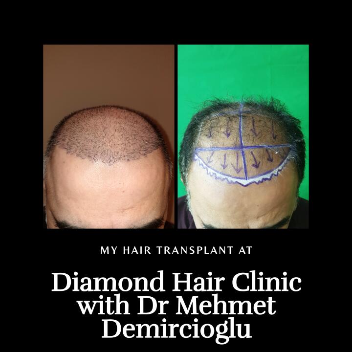 Diamond Hair Clinic & Dr. Mehmet Demircioglu - Hair Transplant Turkey Reviews 2024 5 star review on 29th January 2020