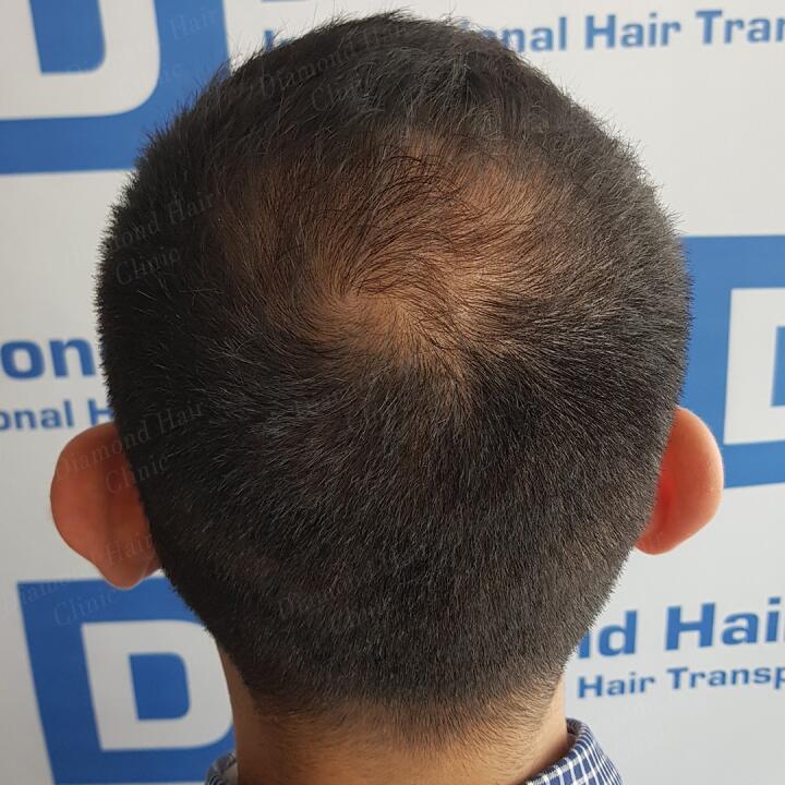 Diamond Hair Clinic & Dr. Mehmet Demircioglu - Hair Transplant Turkey Reviews 2024 5 star review on 26th June 2020